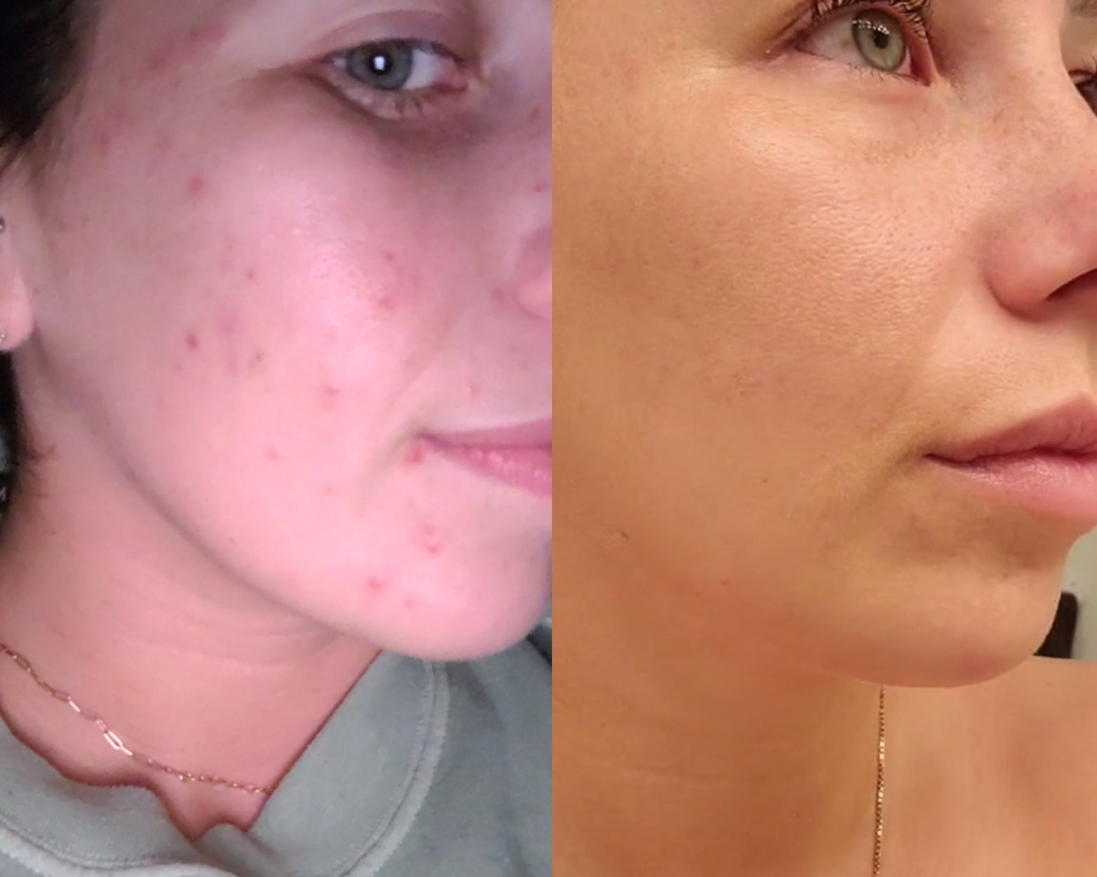 A Nutritionist's journey to healing her skin!