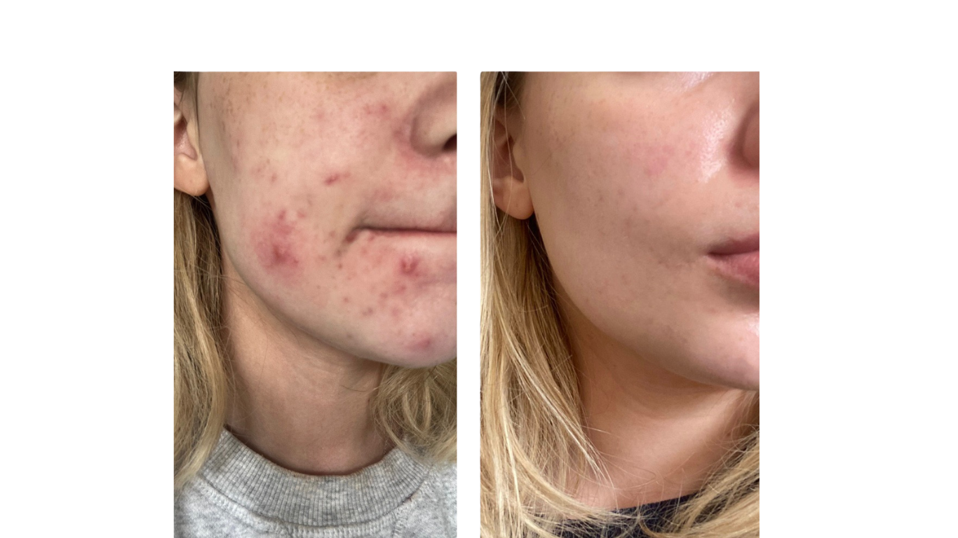 before and after acne transformation